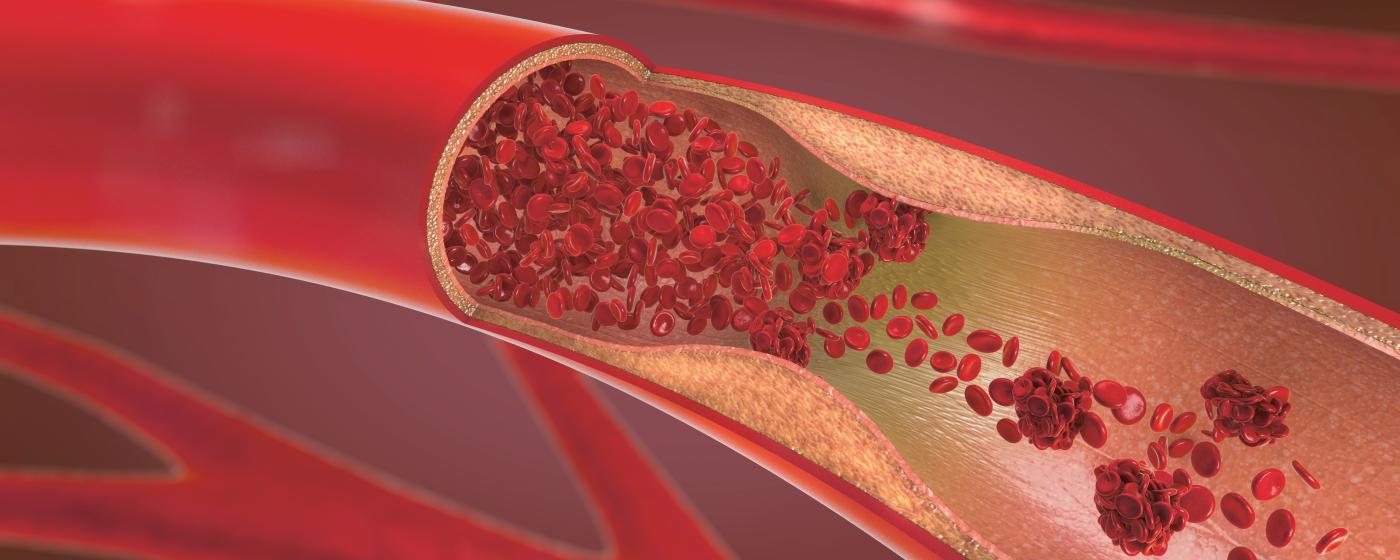 Thrombose: Wenn das Blut stockt - DROPA