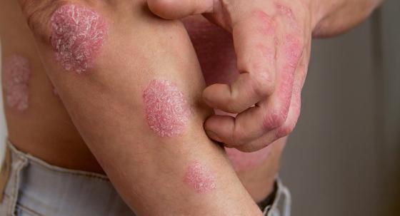 Psoriasis